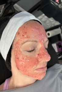 Benefits of Hydrojelly Masks and Paraffin Masks